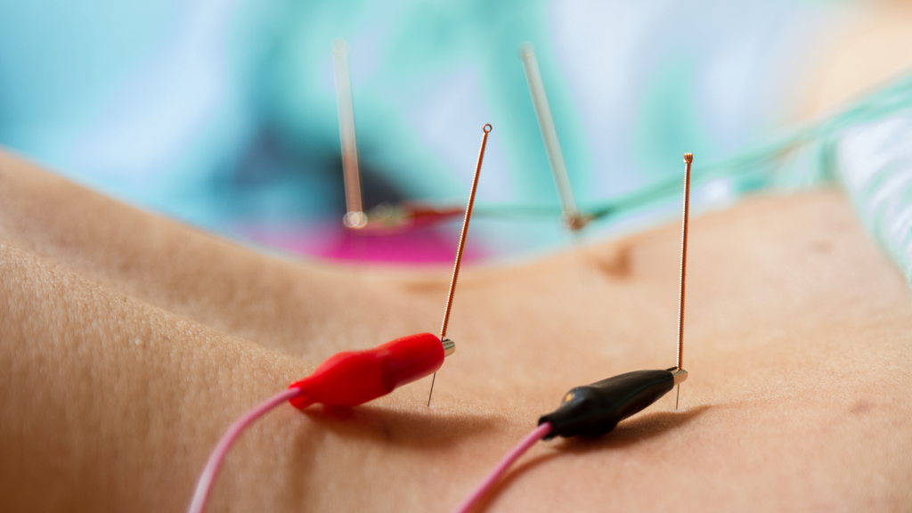 Acupuncture Procedure